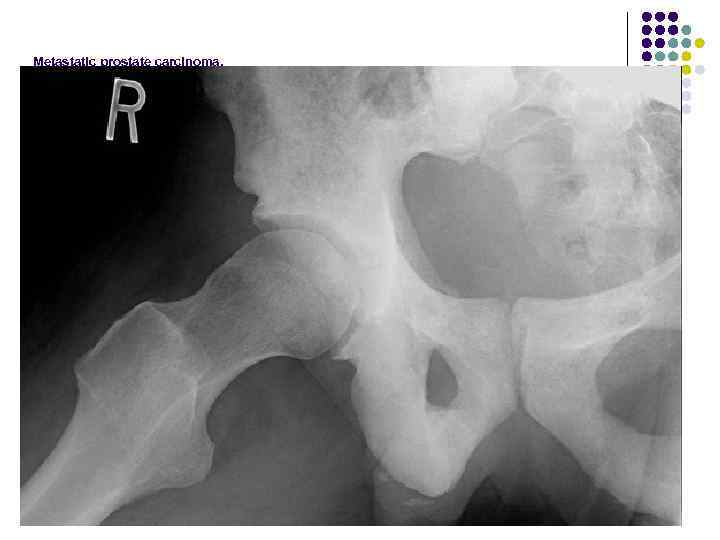 Metastatic prostate carcinoma. 