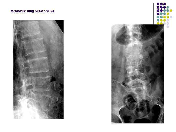 Metastatic lung ca L 2 and L 4 