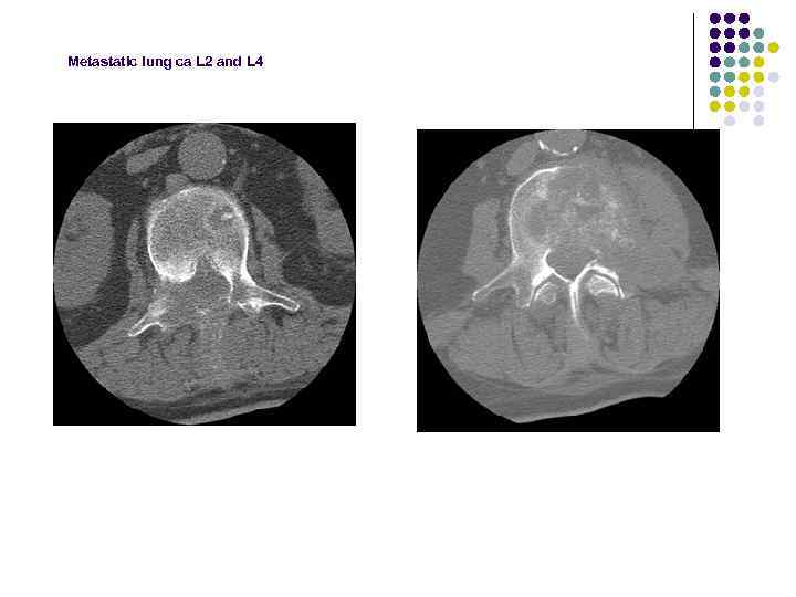 Metastatic lung ca L 2 and L 4 