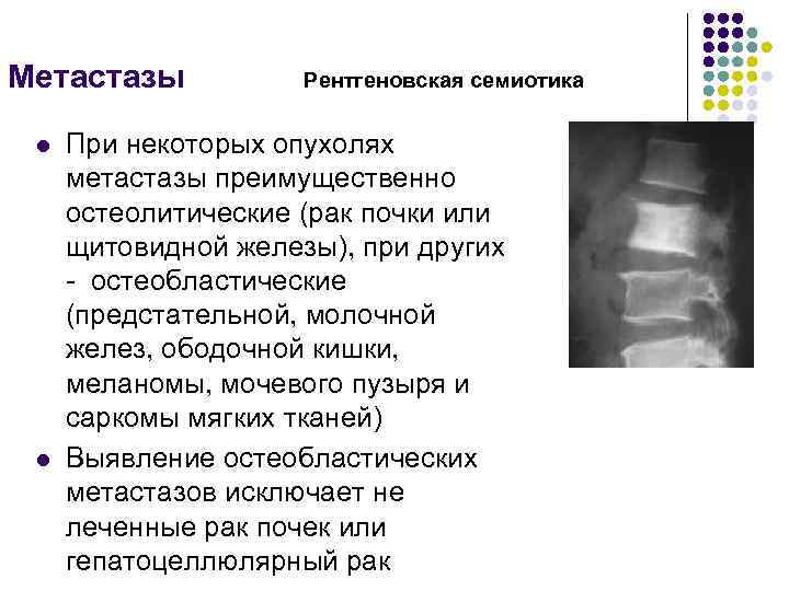 Метастазы l l Рентгеновская семиотика При некоторых опухолях метастазы преимущественно остеолитические (рак почки или