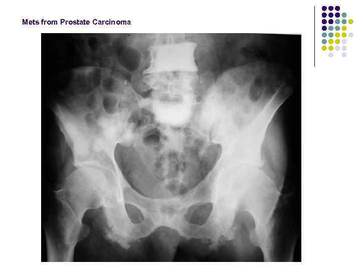 Mets from Prostate Carcinoma 