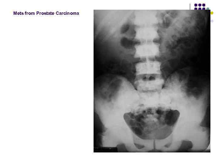 Mets from Prostate Carcinoma 