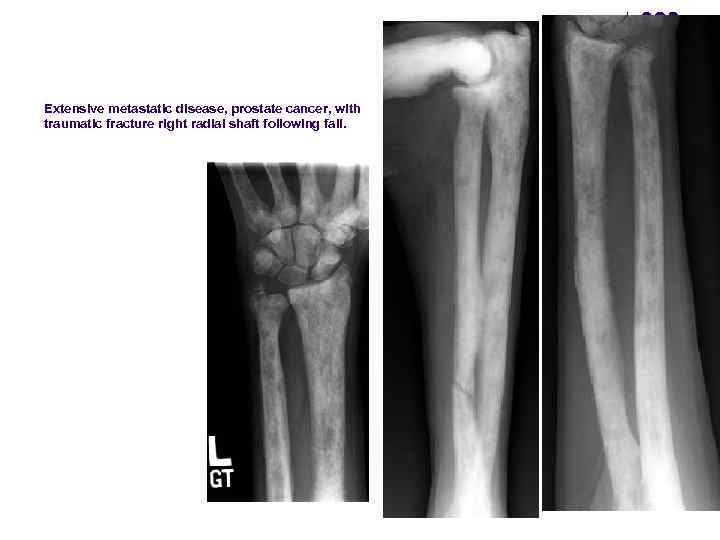 Extensive metastatic disease, prostate cancer, with traumatic fracture right radial shaft following fall. 