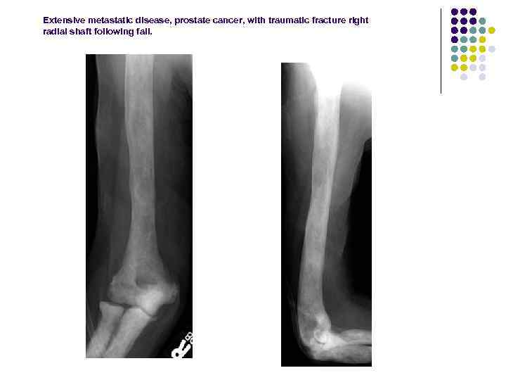 Extensive metastatic disease, prostate cancer, with traumatic fracture right radial shaft following fall. 