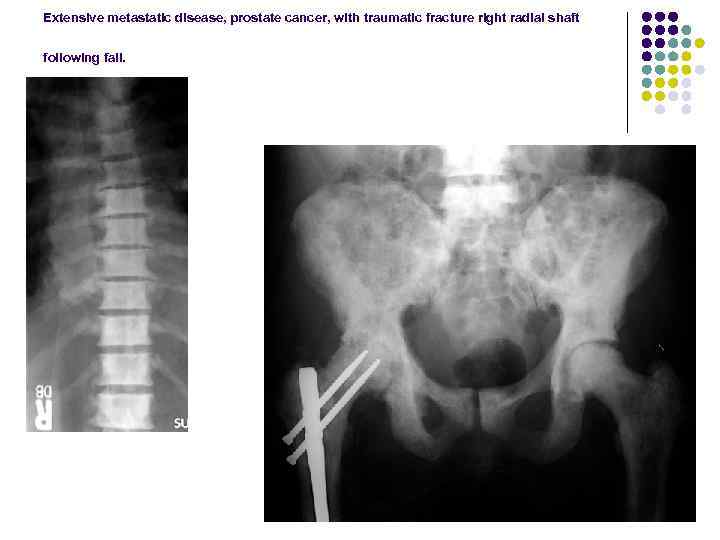 Extensive metastatic disease, prostate cancer, with traumatic fracture right radial shaft following fall. 