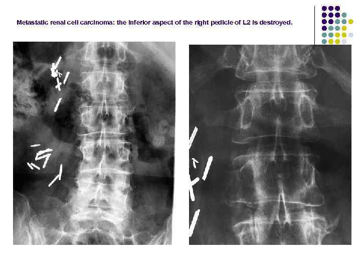 Metastatic renal cell carcinoma: the inferior aspect of the right pedicle of L 2