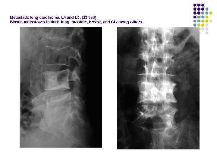 Metastatic lung carcinoma, L 4 and L 5. (33. 330) Blastic metastases include lung,