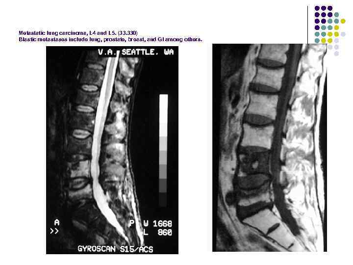 Metastatic lung carcinoma, L 4 and L 5. (33. 330) Blastic metastases include lung,