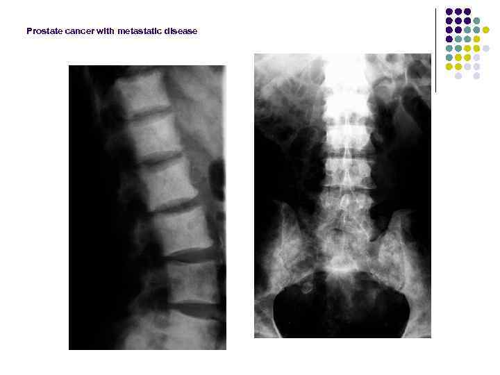 Prostate cancer with metastatic disease 