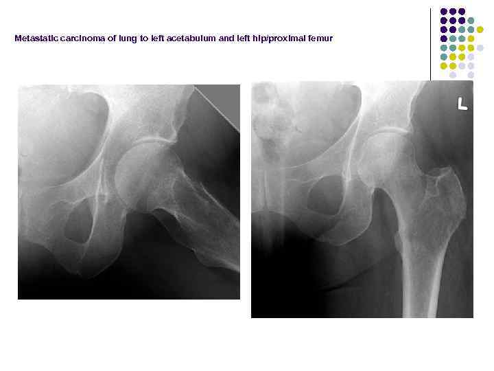 Metastatic carcinoma of lung to left acetabulum and left hip/proximal femur 