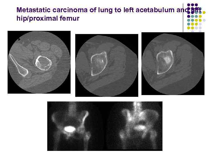 Metastatic carcinoma of lung to left acetabulum and left hip/proximal femur 