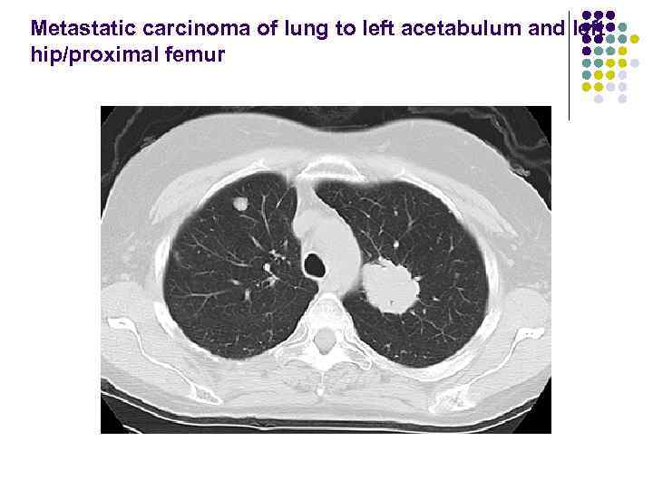 Metastatic carcinoma of lung to left acetabulum and left hip/proximal femur 