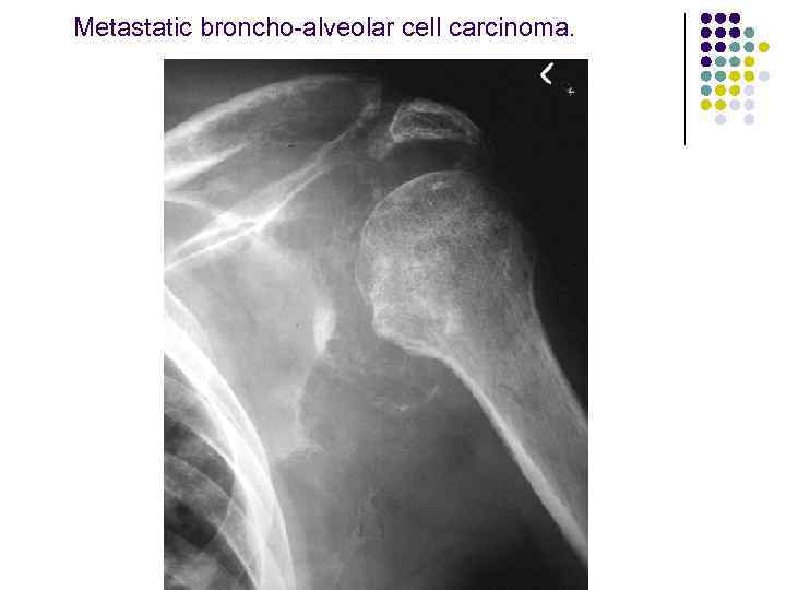 Metastatic broncho-alveolar cell carcinoma. 