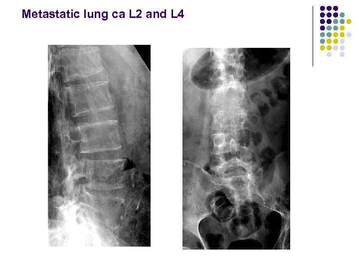 Metastatic lung ca L 2 and L 4 