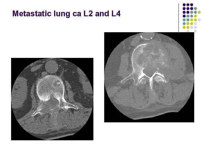 Metastatic lung ca L 2 and L 4 