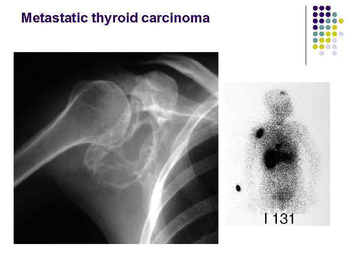 Metastatic thyroid carcinoma 