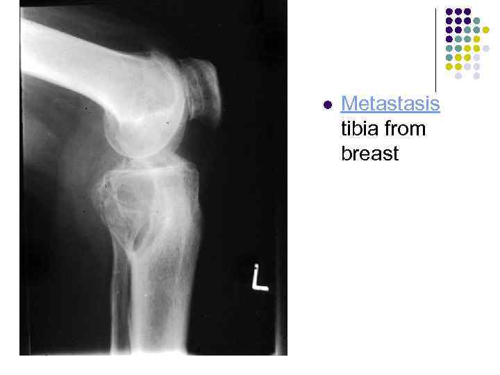 l Metastasis tibia from breast 