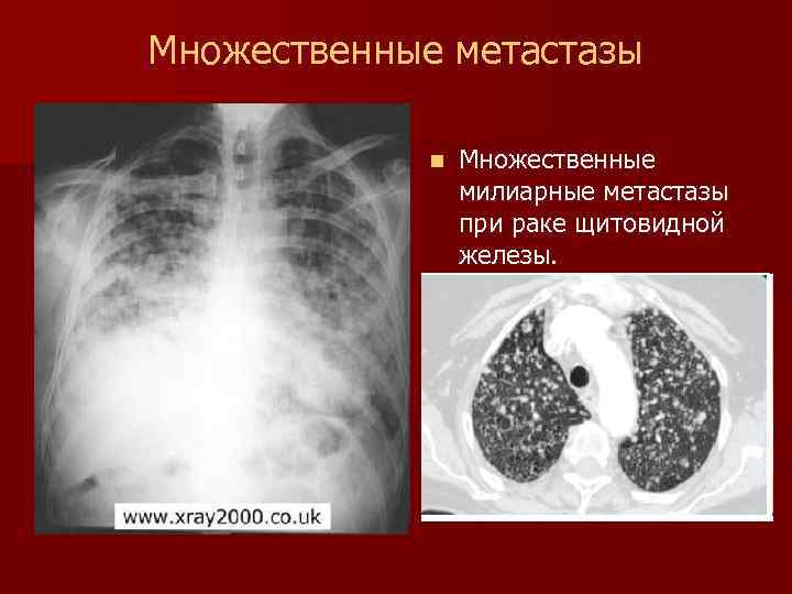 Лучевая диагностика рака легкого презентация