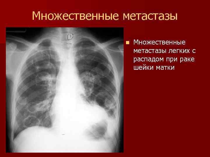 Множественные метастазы n Множественные метастазы легких с распадом при раке шейки матки 
