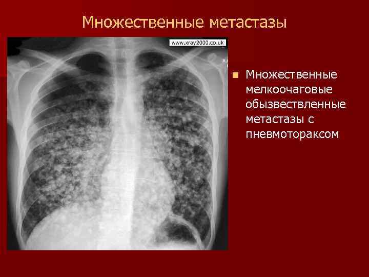 Метастазы в легких рентгенологическая картина