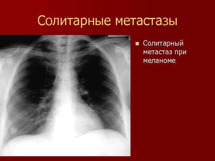 Солитарные метастазы n Солитарный метастаз при меланоме 