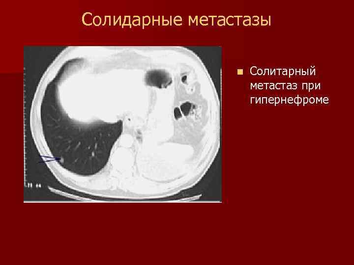 Солидарные метастазы n Солитарный метастаз при гипернефроме 
