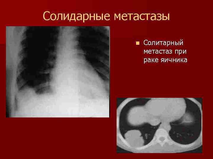 Метастазы при раке яичников фото