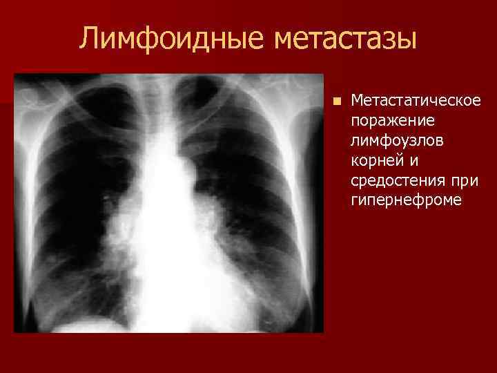Лимфоидные метастазы n Метастатическое поражение лимфоузлов корней и средостения при гипернефроме 