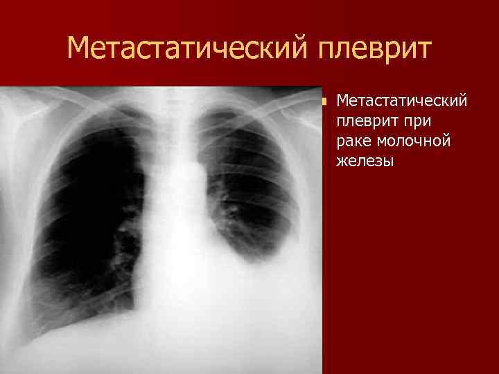 Метастатический плеврит n Метастатический плеврит при раке молочной железы 
