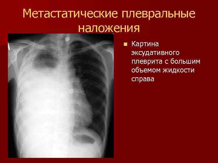 Метастатические плевральные наложения n Картина эксудативного плеврита с большим объемом жидкости справа 