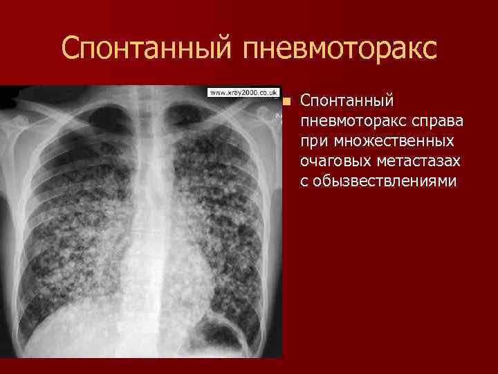 Спонтанный пневмоторакс n Спонтанный пневмоторакс справа при множественных очаговых метастазах с обызвествлениями 