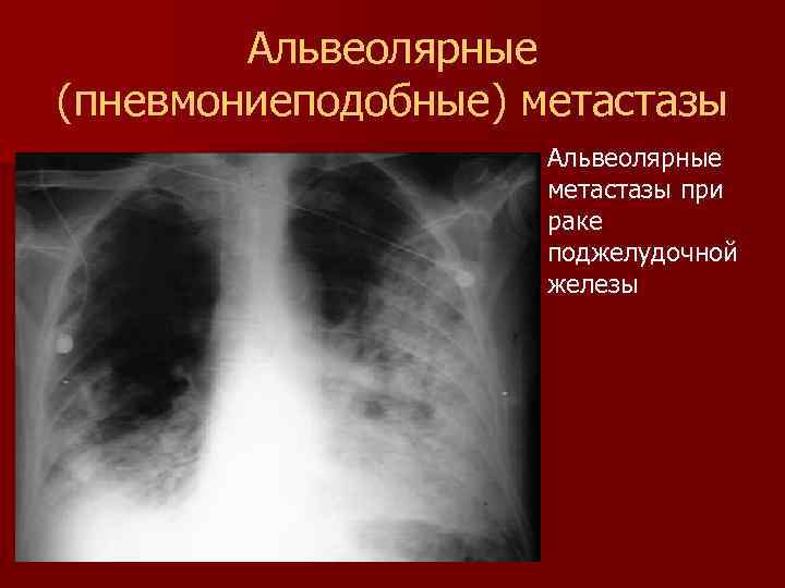 Лучевая диагностика опухолей поджелудочной железы презентация