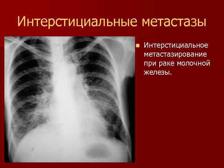 Интерстициальные метастазы n Интерстициальное метастазирование при раке молочной железы. 