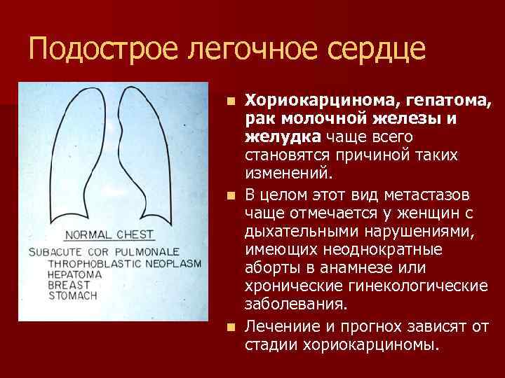 Подострое легочное сердце Хориокарцинома, гепатома, рак молочной железы и желудка чаще всего становятся причиной