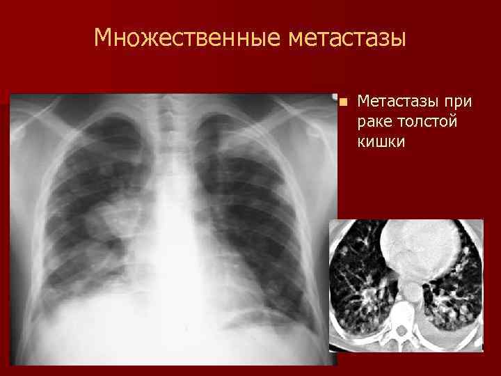 Множественные метастазы n Метастазы при раке толстой кишки 