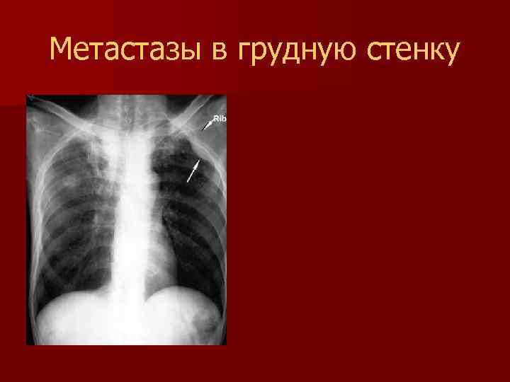 Метастазы в грудную стенку 