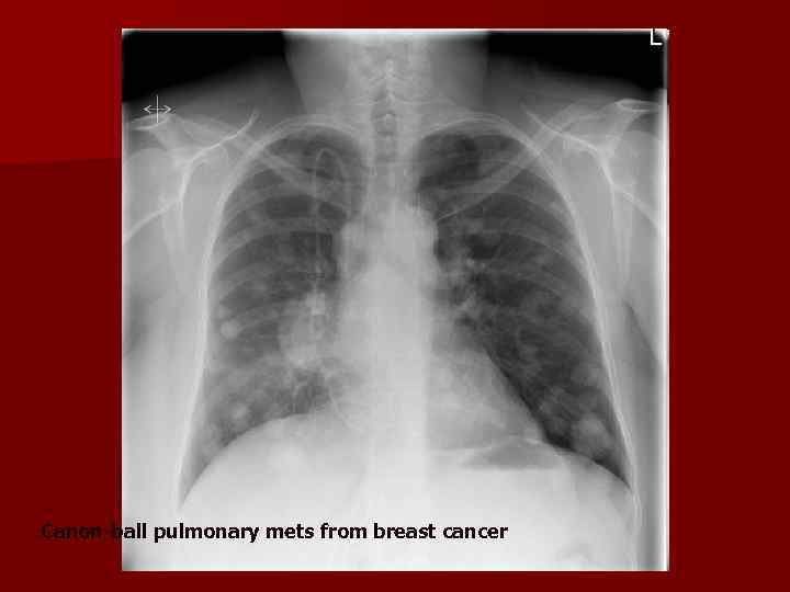 Canon-ball pulmonary mets from breast cancer 