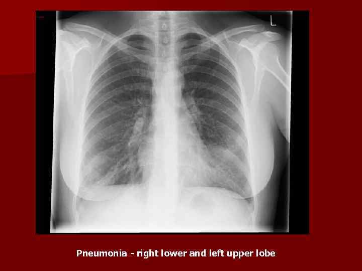 Pneumonia - right lower and left upper lobe 