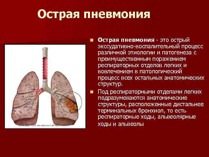 Сухая пневмония. Острая пневмония начало. Острое воспаление легких. Острая респираторная пневмония.