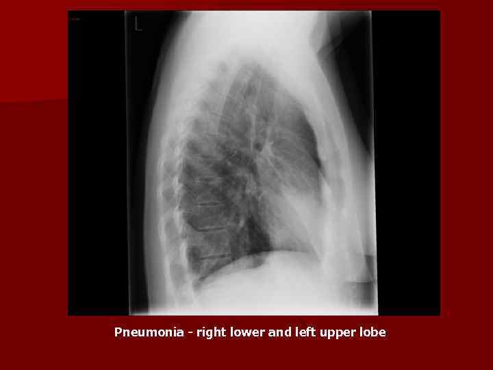 Pneumonia - right lower and left upper lobe 