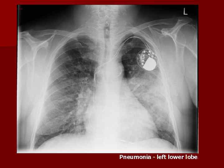 Pneumonia - left lower lobe 