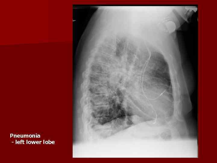 Pneumonia - left lower lobe 