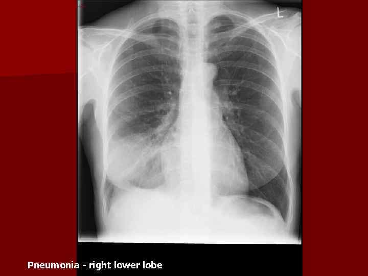 Pneumonia - right lower lobe 