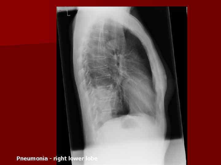 Pneumonia - right lower lobe 