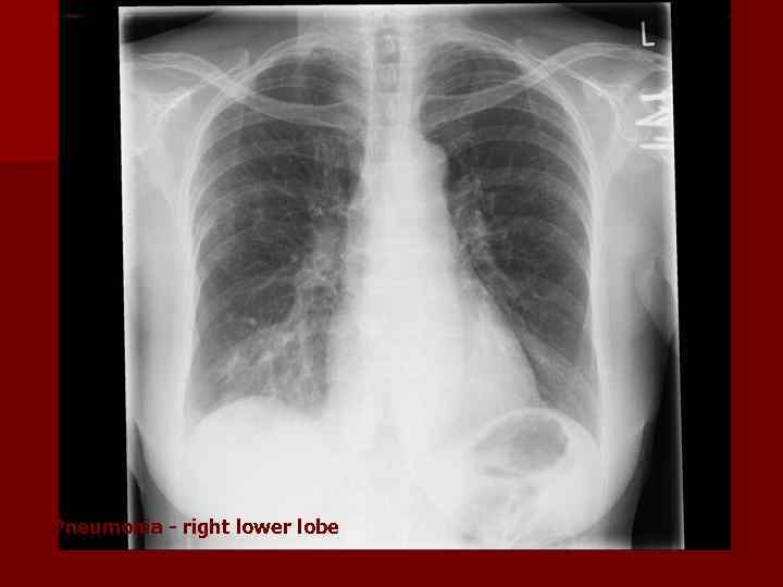 Pneumonia - right lower lobe 