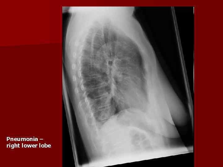 Pneumonia – right lower lobe 