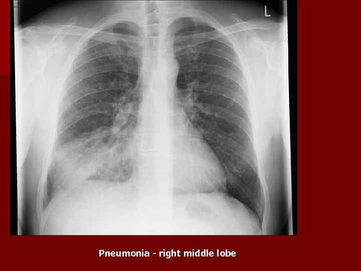 Pneumonia - right middle lobe 