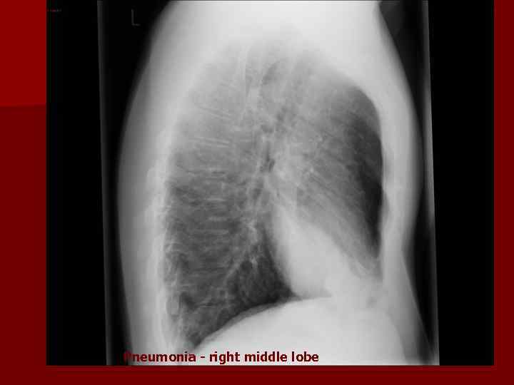 Pneumonia - right middle lobe 