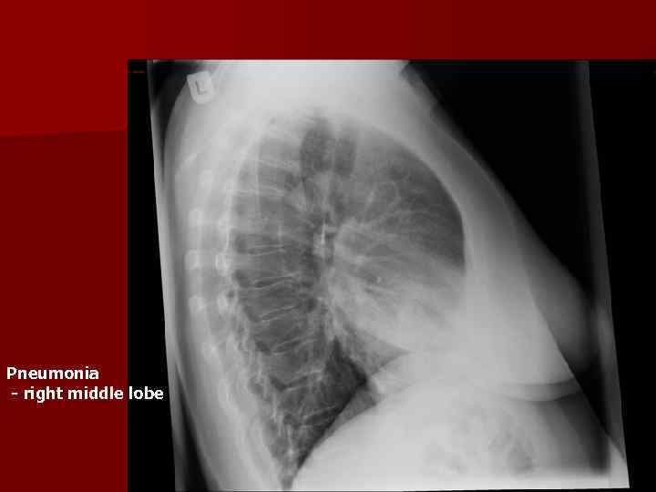 Pneumonia - right middle lobe 