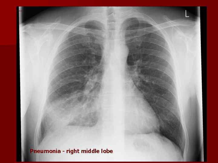 Pneumonia - right middle lobe 